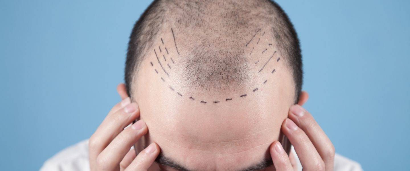 Esteba Clinic | DHI Saç Ekimi, Erkek Tipi Saç Dökülmesini Tedavi Etmenin En Etkili Yolu