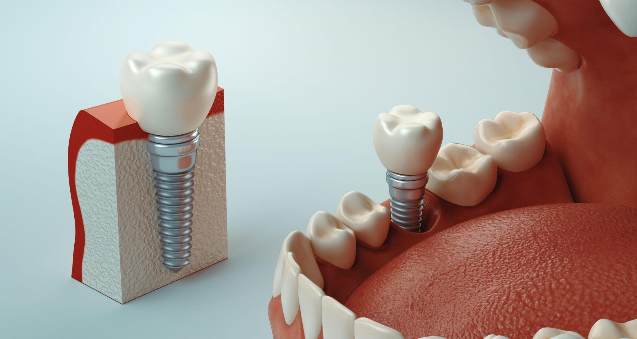 Esteba Clinic | Diş İmplantları: Gülüşünüzü Yeniden Kazanmanın Etkili Yolu