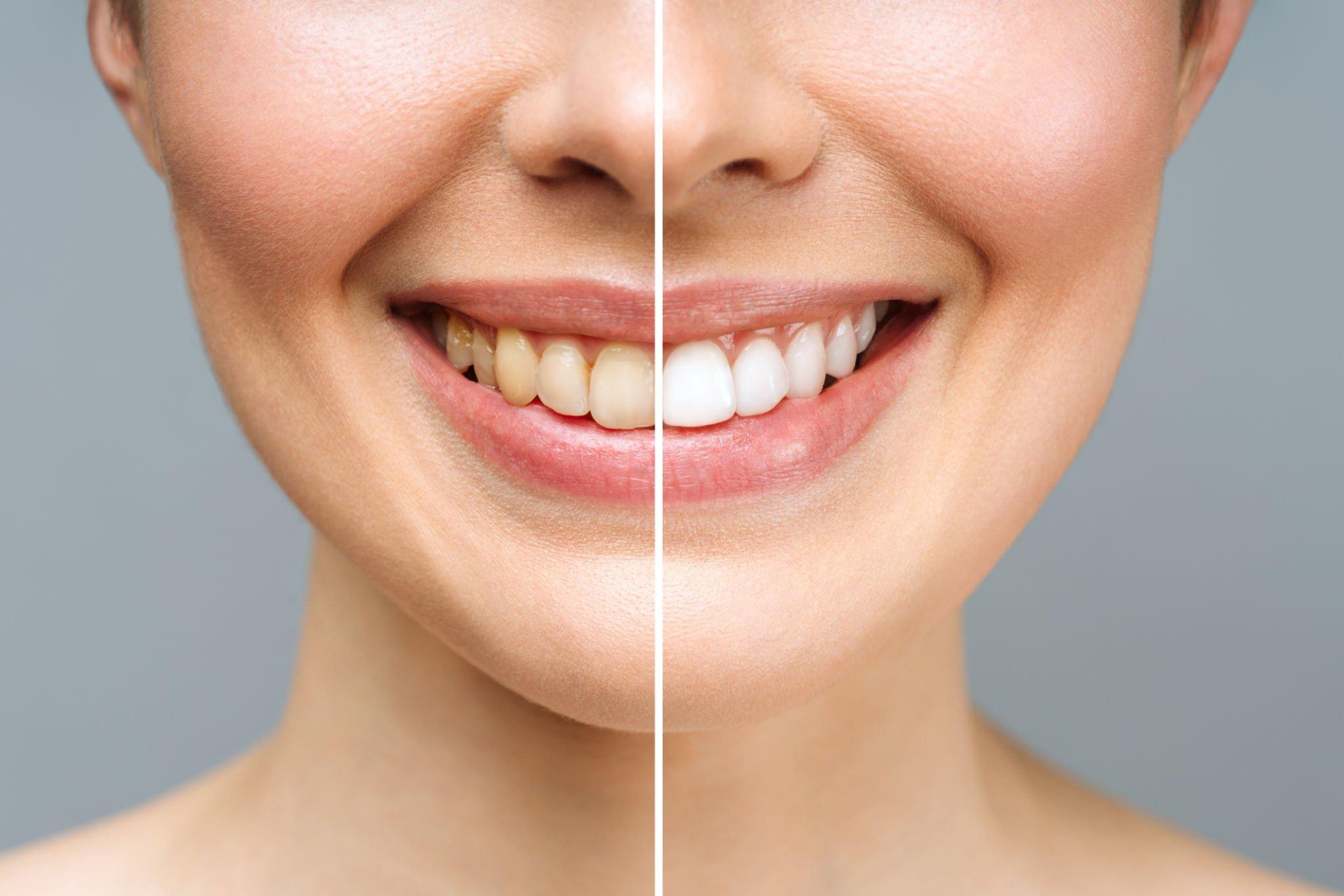 Esteba Clinic | Diş Beyazlatma: Gülümsemenizi Aydınlatmak için Doğal Yollar
