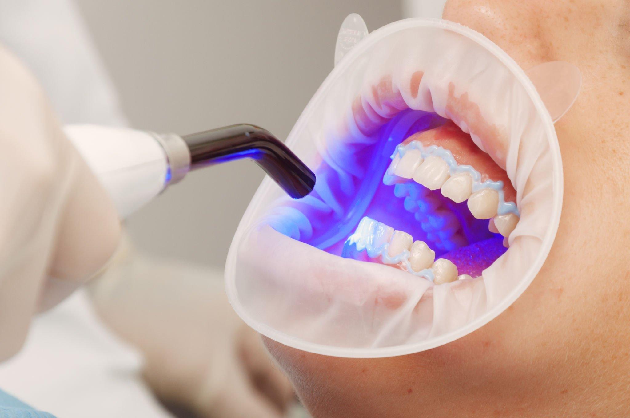 Esteba Clinic | Diş Beyazlatma