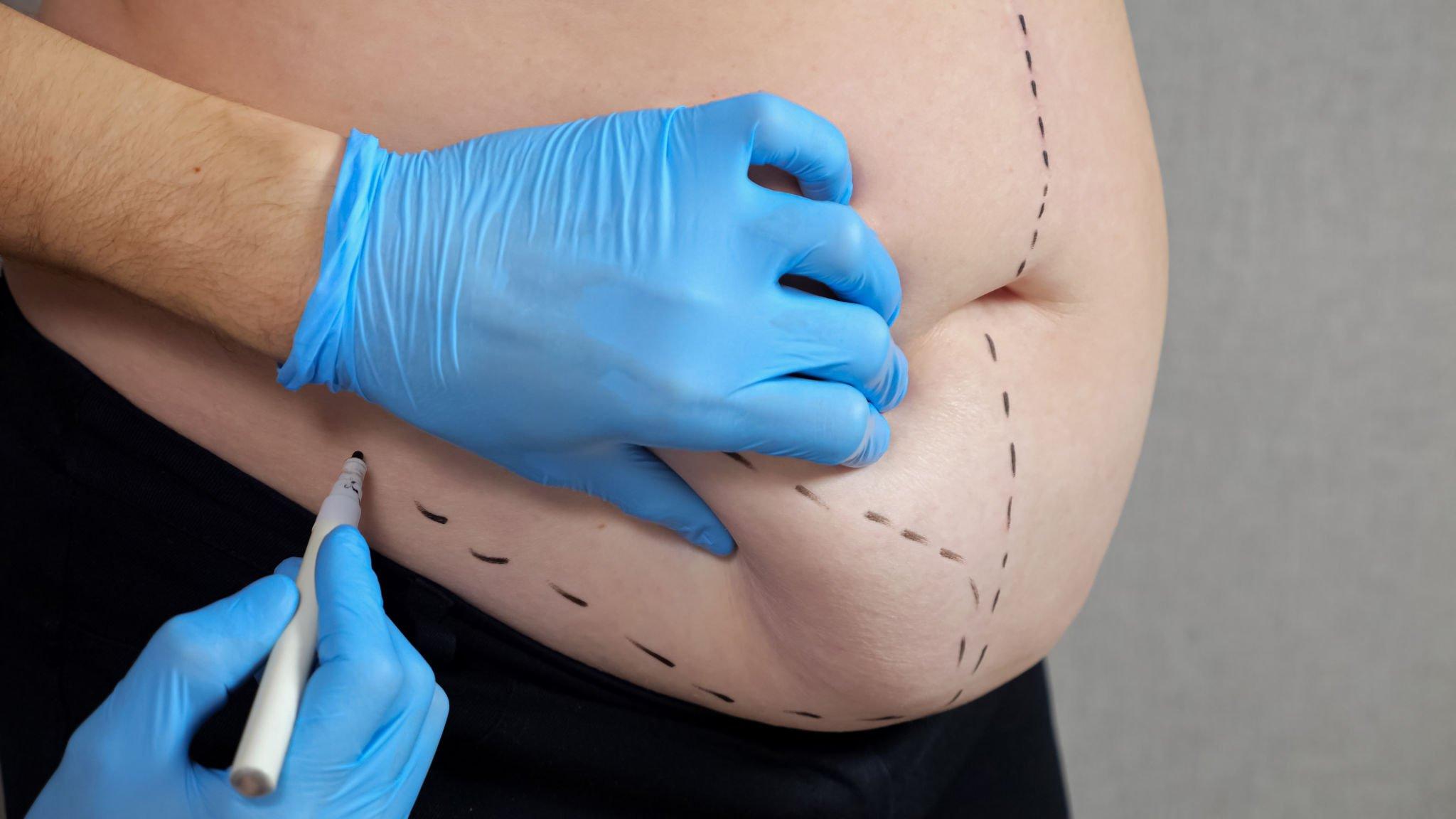 Esteba Clinic | Liposuction Sonrası Sonuçlar Daha Doğal Görünüyor