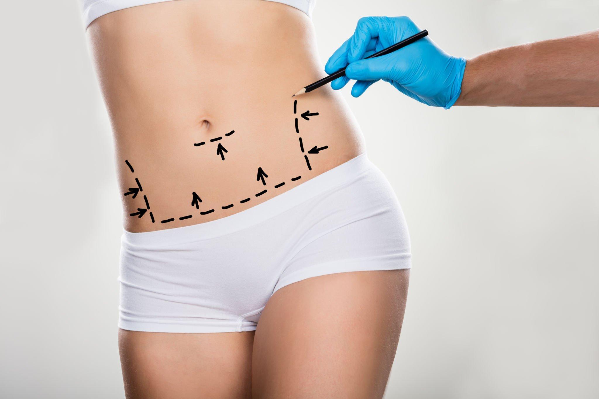 Esteba Clinic | Abdominoplasty-Tummy tuck(Karın germe)