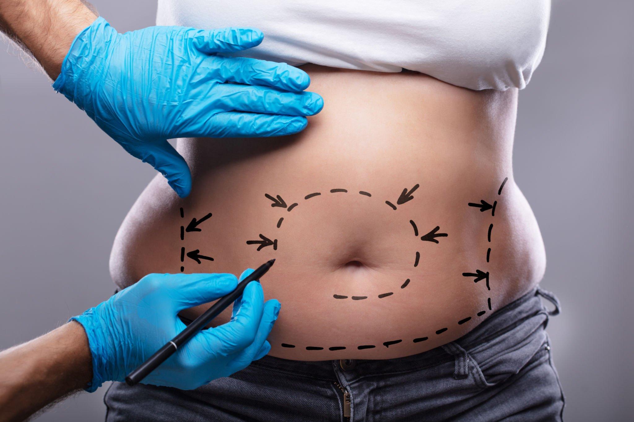 Esteba Clinic | Liposuction